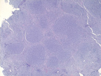 Follicular-Lymphoma-Grade-3aHE
