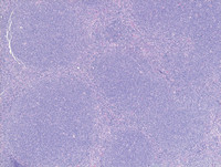 Follicular-Lymphoma-Grade-3aHE