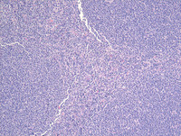 Follicular-Lymphoma-Grade-3aHE
