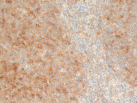 Follicular-Lymphoma-Grade-3aHGAL
