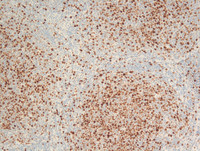 Follicular-Lymphoma-Grade-3aKi67