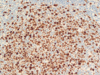 Follicular-Lymphoma-Grade-3aKi67