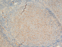 Follicular-Lymphoma-Grade-3aLMO2