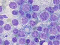 Follicular-Lymphoma-Grade-3aTouch-Prep