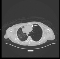PlasmacytomaLike-PTLD-EBV-CT-Scan