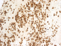 Primary-Effusion-LymphomaCD30