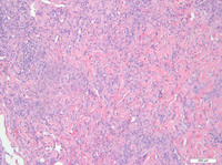 Primary-Effusion-LymphomaHE