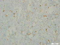 Primary-Effusion-LymphomaHHV8