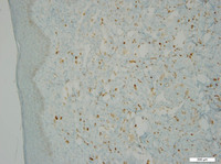 Primary-Effusion-LymphomaHHV8