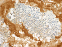 Primary-Effusion-LymphomaKappa