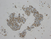 Primary-Effusion-LymphomaMUM1