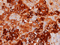 Extracavitary-Primary-Effusion-LymphomaIgM