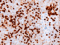 Extracavitary-Primary-Effusion-LymphomaPAX5