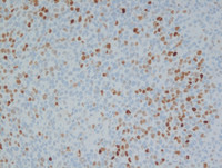 Nodal-Follicular-LymphomaCMyc