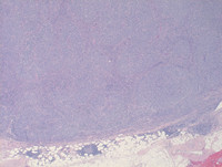 Follicular Lymphoma, grade 3B