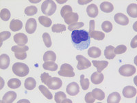 Chronic Lymphoproliferative Disorder of NK Cells