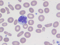 Chronic-Lymphoproliferative-Disorder-of-NK-Cells--Blood
