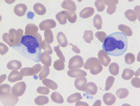 Chronic-Lymphoproliferative-Disorder-of-NK-Cells--Blood
