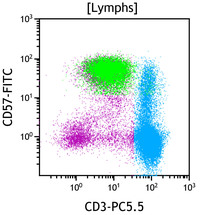 Chronic-Lymphoproliferative-Disorder-of-NK-Cells--Flow-Plots