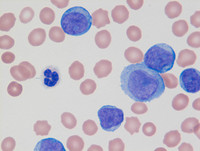 Mixed-Phenotype-Acute-Leukemia-Bmyeloid-Blood