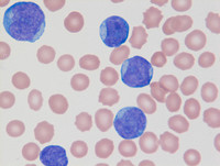 Mixed-Phenotype-Acute-Leukemia-Bmyeloid-Blood