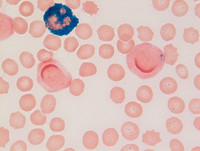 Mixed-Phenotype-Acute-Leukemia-Bmyeloid-Blood