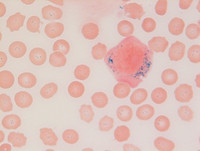 Mixed-Phenotype-Acute-Leukemia-Bmyeloid-Blood