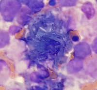 Crystal-storing histiocytosis