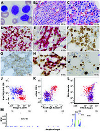 Hairy cell leukemia coexistent with chronic lymphocytic leukemia