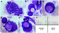 Cannibalistic acute myeloid leukemia with ZMYND11-MBTD1 fusion