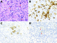 Concurrent diagnosis of classical Hodgkin lymphoma and Langerhans cell histiocytosis
