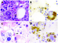 Seronegative visceral leishmaniasis with bone marrow and hepatic involvement