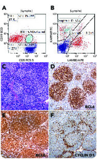 Follicular lymphoma with composite in situ mantle cell neoplasia