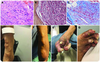 Refractory gout in primary myelofibrosis