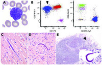 HTLV-1–associated adult T-cell leukemia/lymphoma with disseminated strongyloidiasis