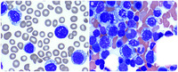 Mantle cell lymphoma with unusual Burkitt-like morphologic features