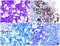 An unusual cause of lymphadenopathy: when AFB staining is not enough