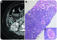 Triple hit B-cell lymphoma with diffuse kidney involvement sparing the glomeruli
