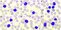 Marked lymphocytosis and atypical cells with a cleft nucleus in a 1-month-old child