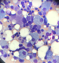 Pseudo-Gaucher cells