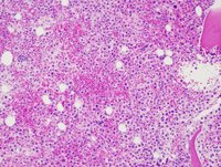 Core biopsy, Plasmacytoid Cells