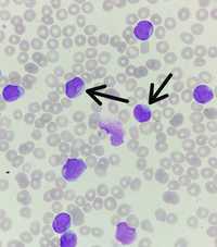 Cup-like blasts in AML