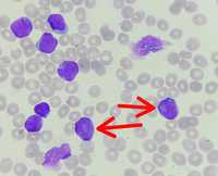 Cup-like blasts in AML