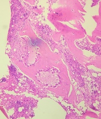 RENAL OSTEODYSTROPHY 1