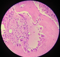 RENAL OSTEODYSTROPHY 3