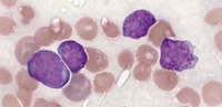 Acute Lymphoblastic Leukemia with Pseudo Chediak Higashi inclusions