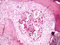 Primary hyperoxaluria