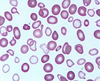 Case history of a child with X-linked congenital sideroblastic anemia.