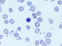 A north Indian child with Congenital dyserythropoietic anemia type II