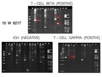 Indolent-Tcell-Lymphoproliferative-Disorder-TCR-Gamma--TCR-Beta
